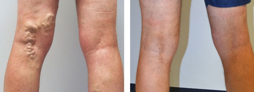 Φωτογραφία πριν και μετά τη χρήση του Veniselle, η εμπειρία της χρήσης κρέμας