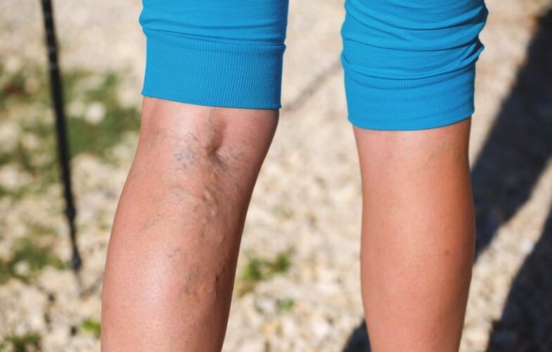 Ζημιά στα κάτω άκρα