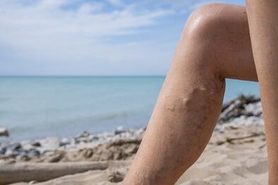 Κιρσοί φλέβες στα πόδια