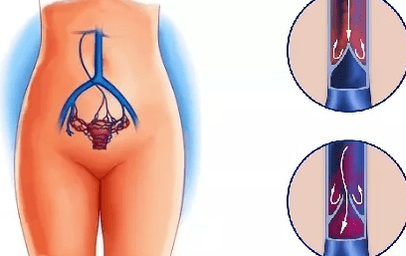 Οι λόγοι για την ανάπτυξη κινεζικών φλεβών της λεκάνης