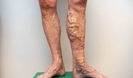 κιρσοί φλέβες στους άνδρες