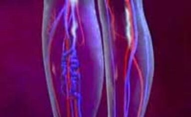 Αιτίες και θεραπεία κιρσών φλεβών