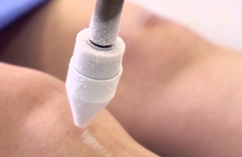 θεραπεία κιρσών στα πόδια με κρυοθεραπεία