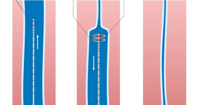 θεραπεία με λέιζερ για κιρσούς στα πόδια