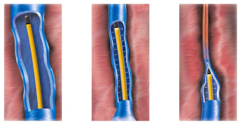 κατάλυση με ραδιοσυχνότητες ως μέθοδος θεραπείας των κιρσών